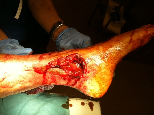 Compound Ankle Fracture